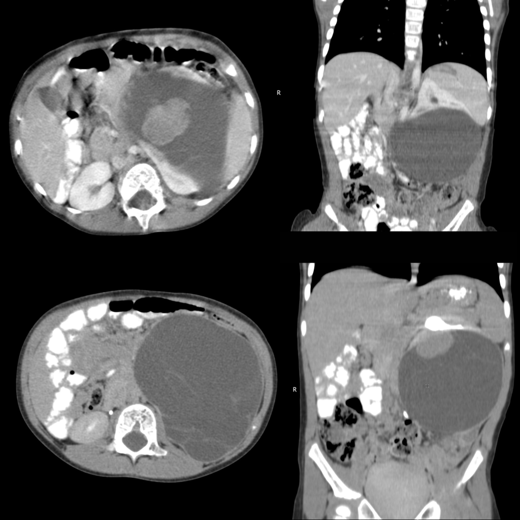 CT of cystic Wilms tumor