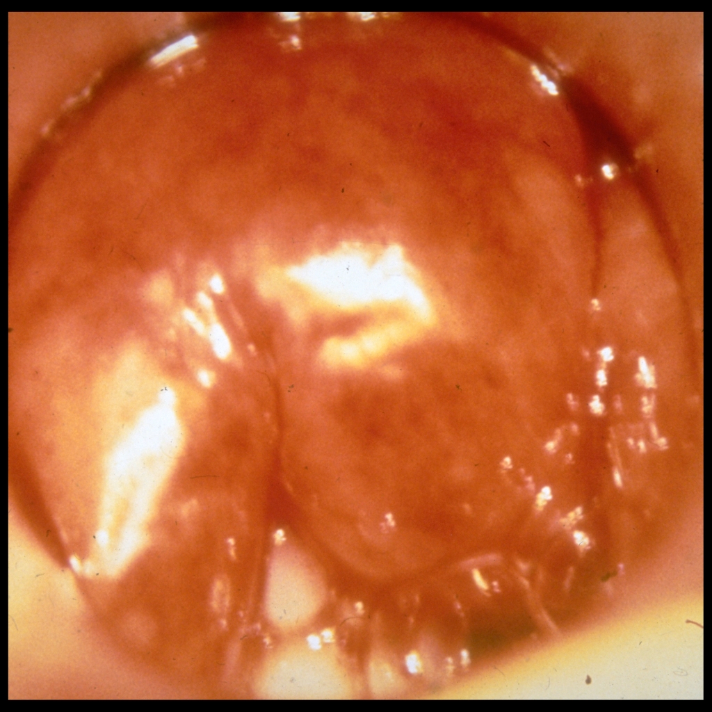 Endoscopy image of epiglottitis