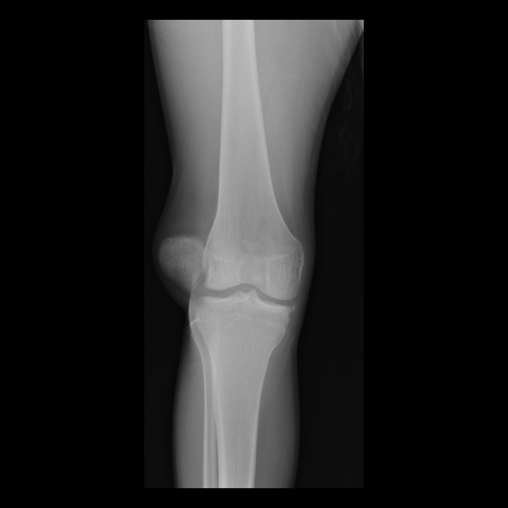 Radiograph of reverse Segond fracture and patellar dislocation