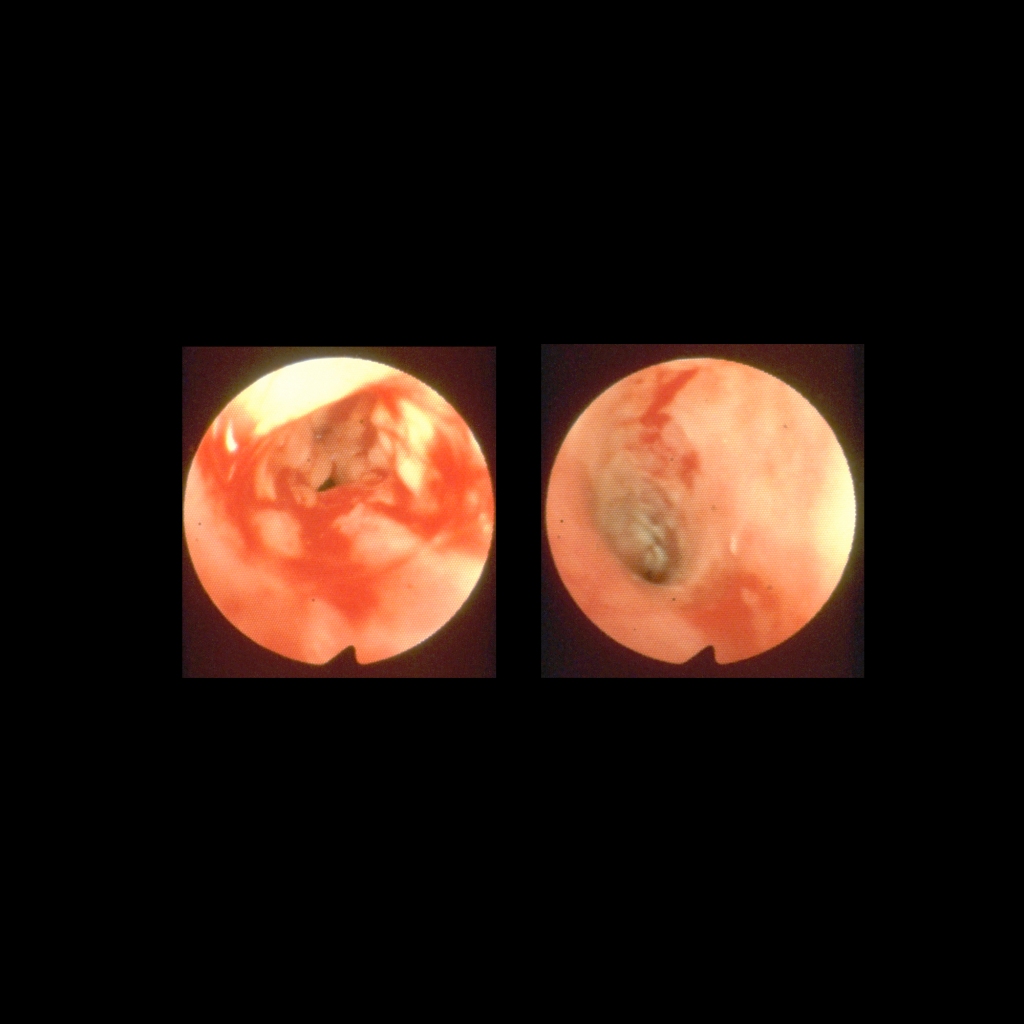 Endoscopy images of esophagitis due to gastroesophageal reflux