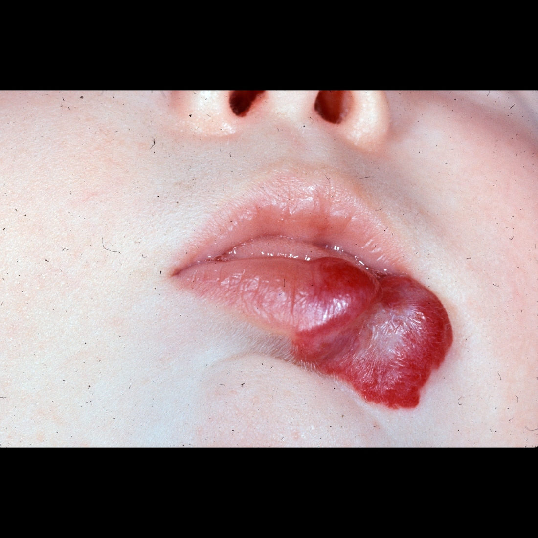Infant with a red lesion near the mouth