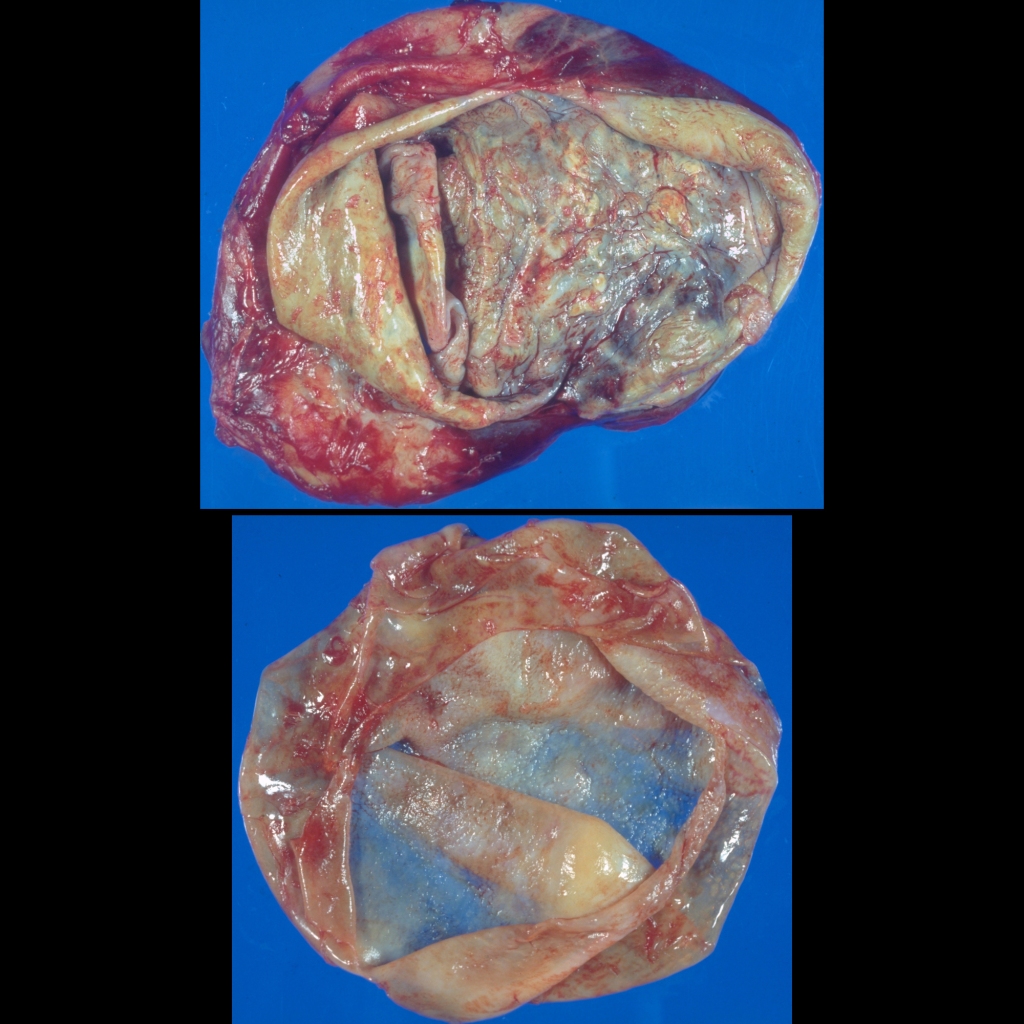 Pathology image of hydatid disease