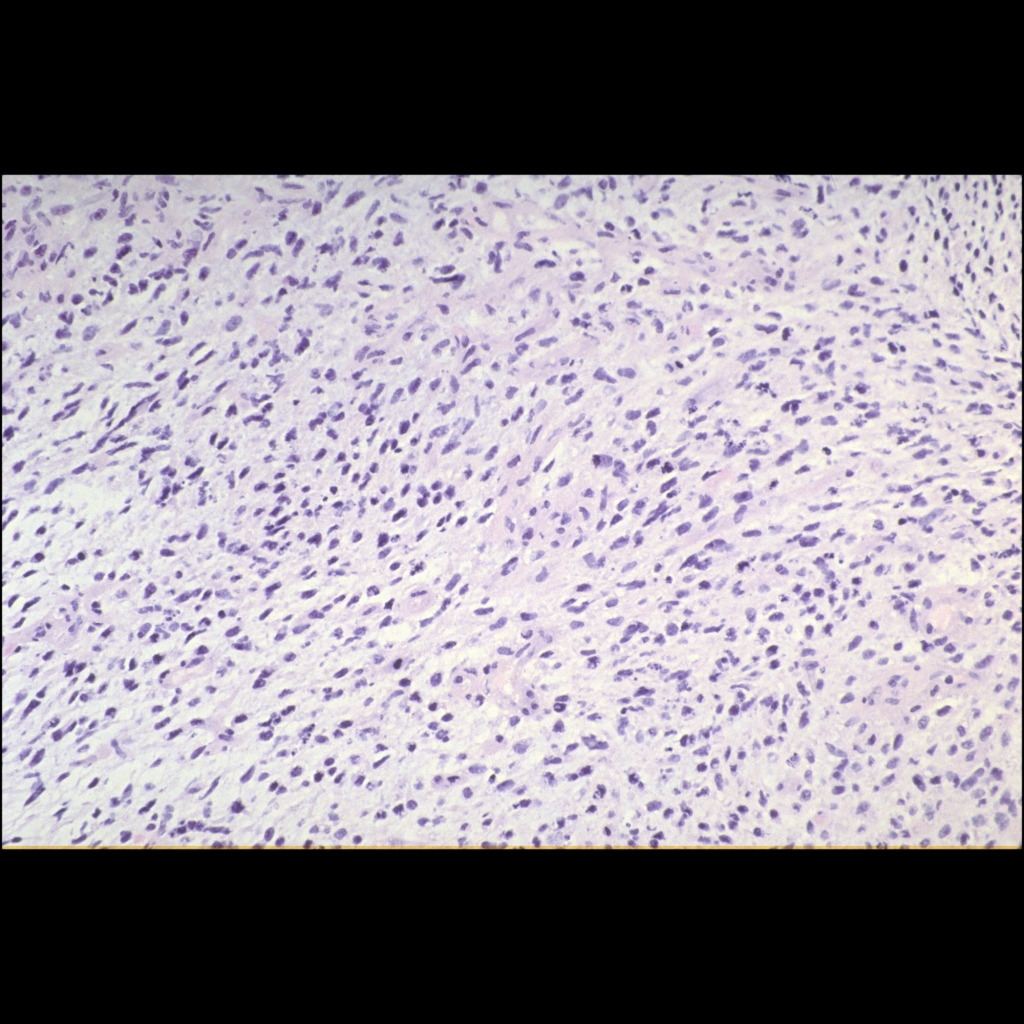 Histopathology image of rhabdomyosarcoma