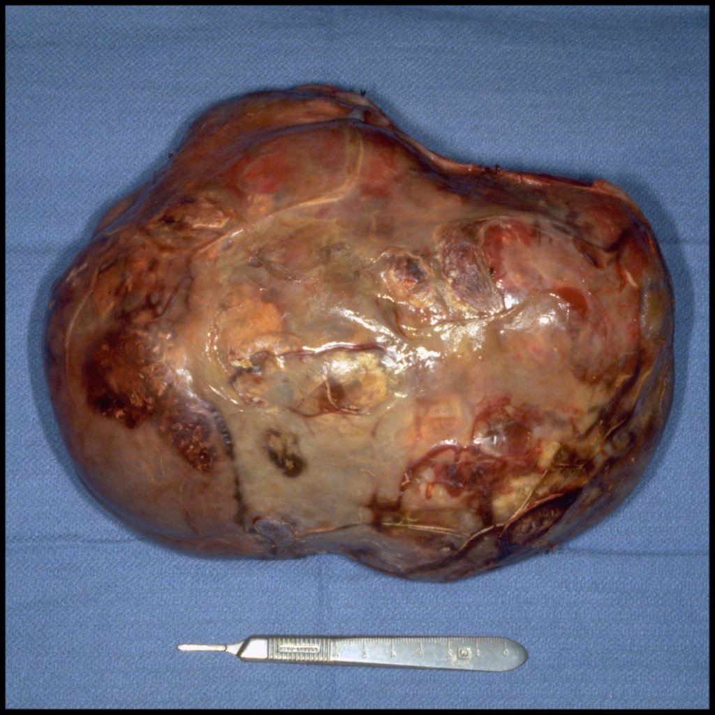 Pathological image of sacrococcygeal teratoma