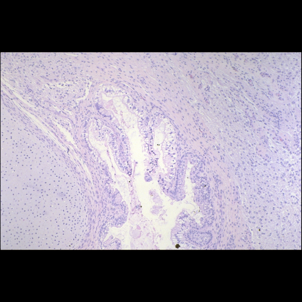 Histopathology image of sacrococcygeal teratoma