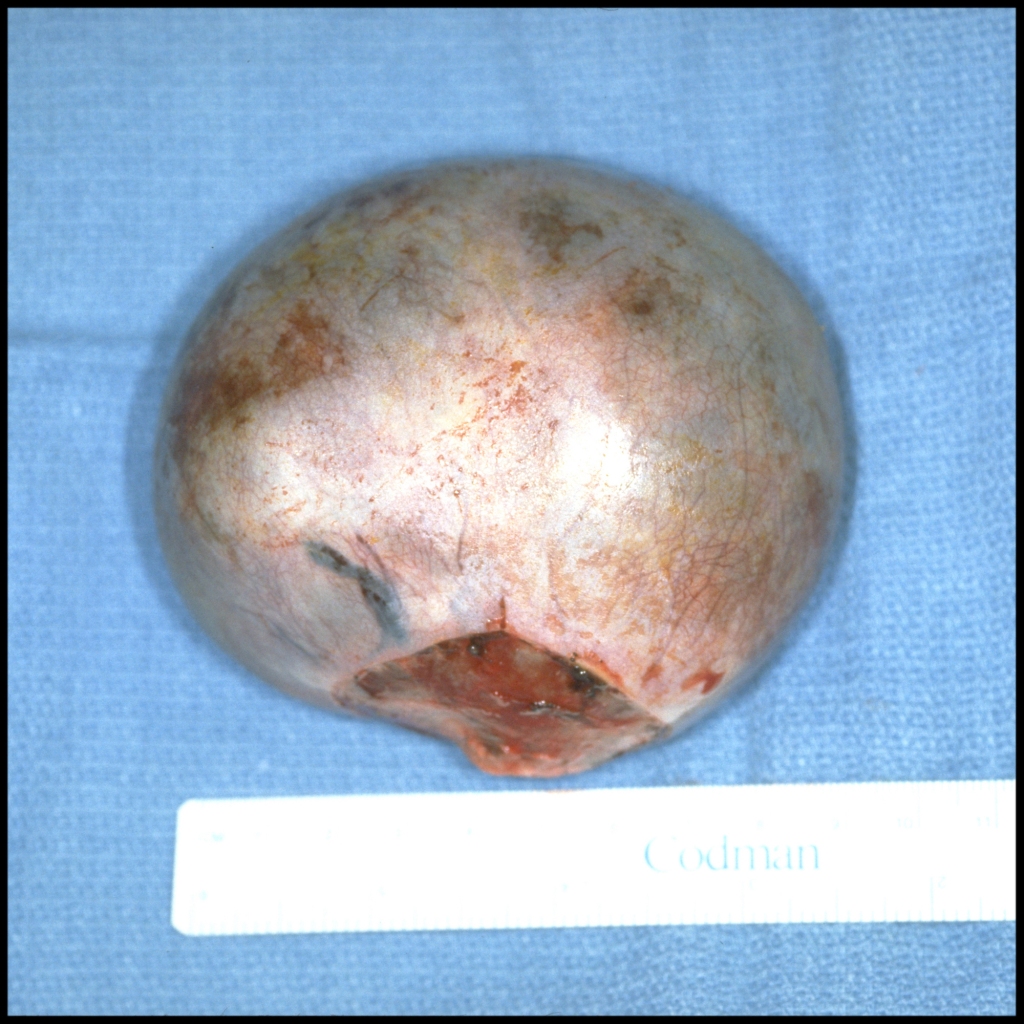 Pathology image of nasal teratoma