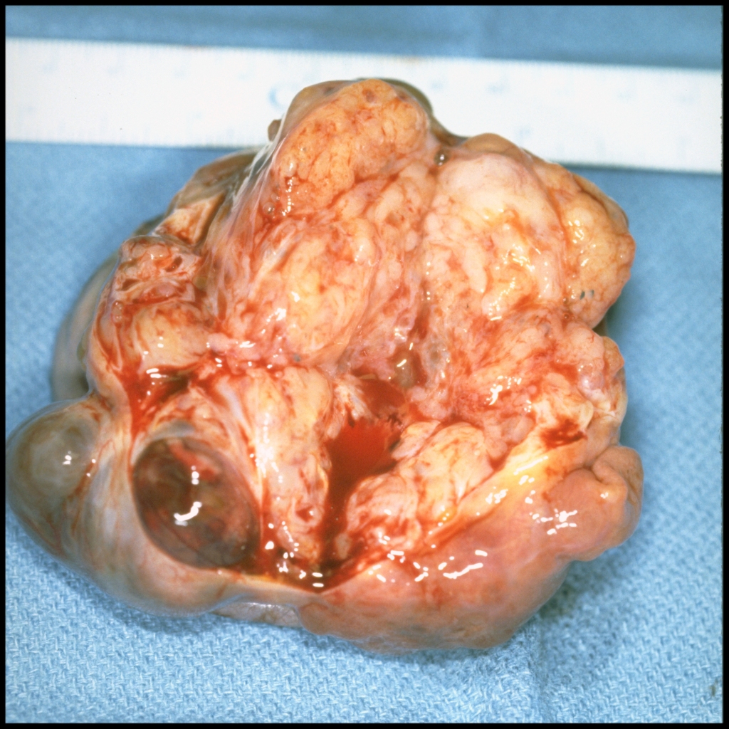 Gross pathology image of nasal teratoma