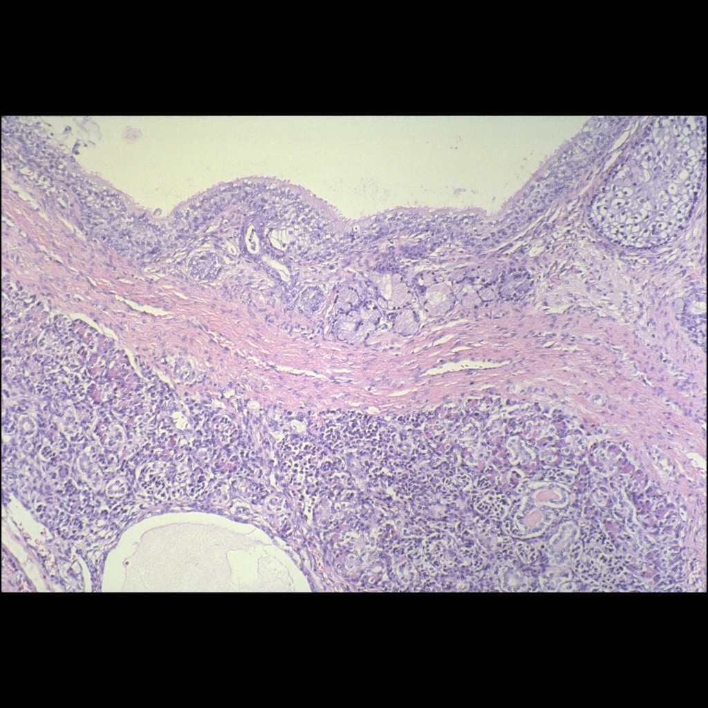 Histopathology image of nasal teratoma