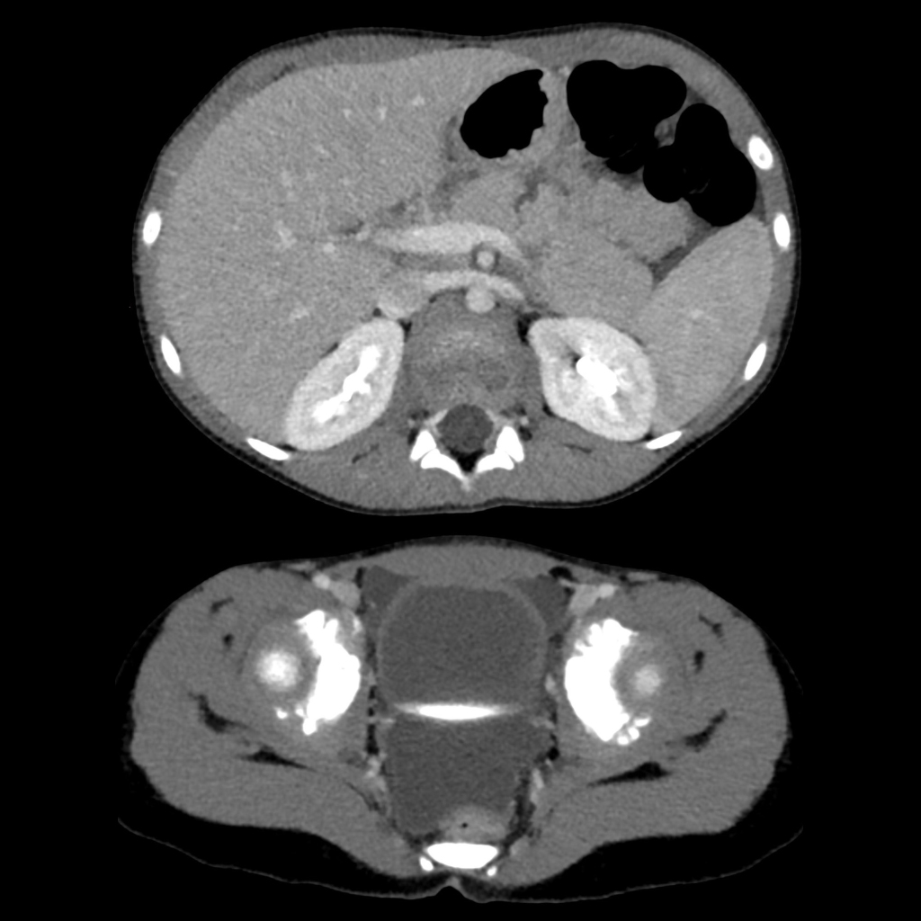 CT of pancreatic transection