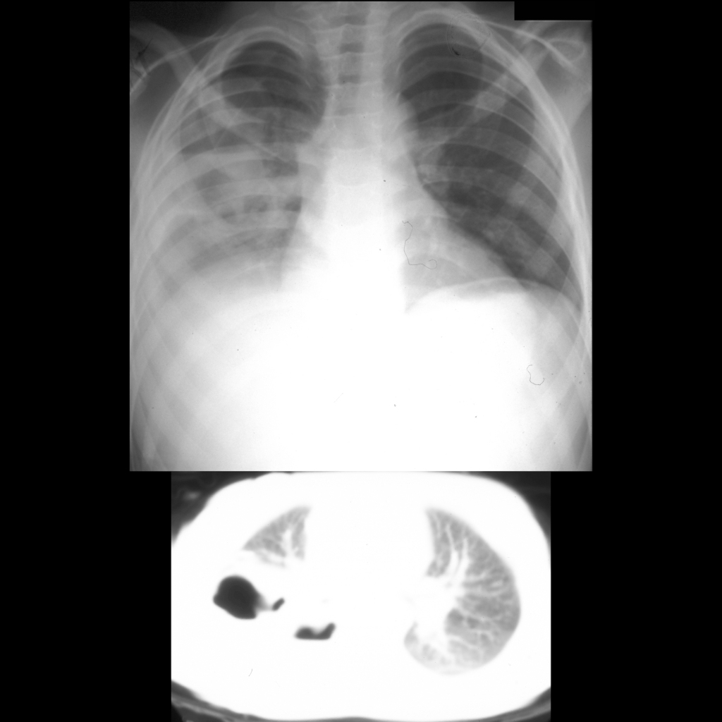 CXR and CT of pulmonary laceration