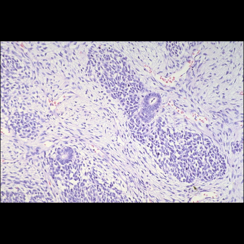 Histopathology image of Wilms tumor