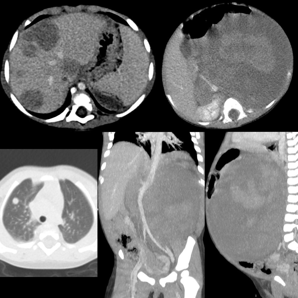 CT of Wilms tumor with lung metastases, liver metastases, and IVC invasion