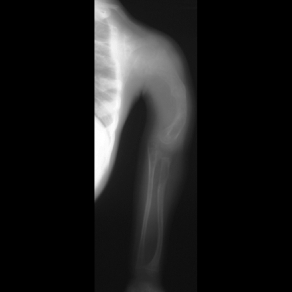 Upper extremity radiograph of osteogenesis imperfecta