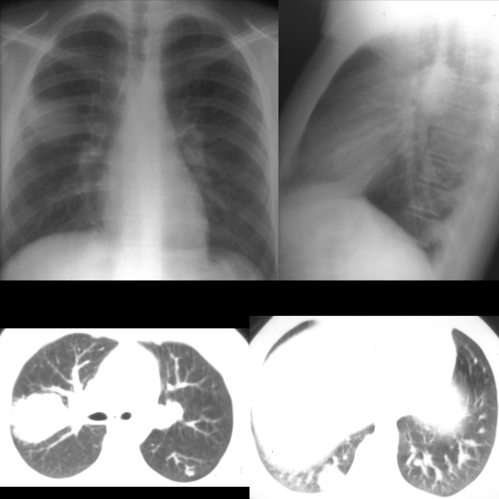 CXR and CT of lung metastases from embryonal cell carcinoma of testicle