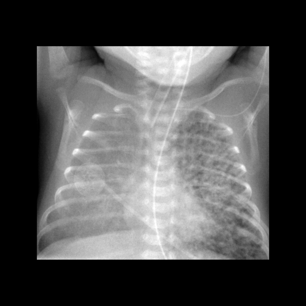 CXR of pulmonary interstitial emphysema