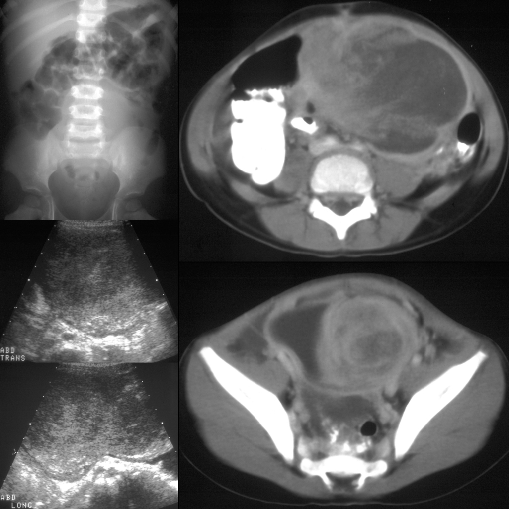 AXR and US and CT of rhabdomyosarcoma of the bladder