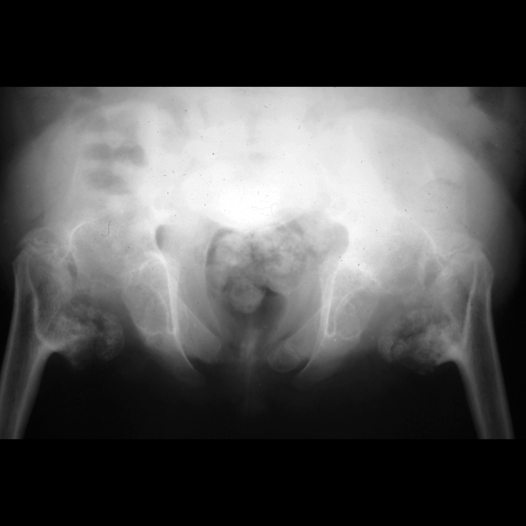 Pelvis radiograph of spondyloepiphyseal dysplasia