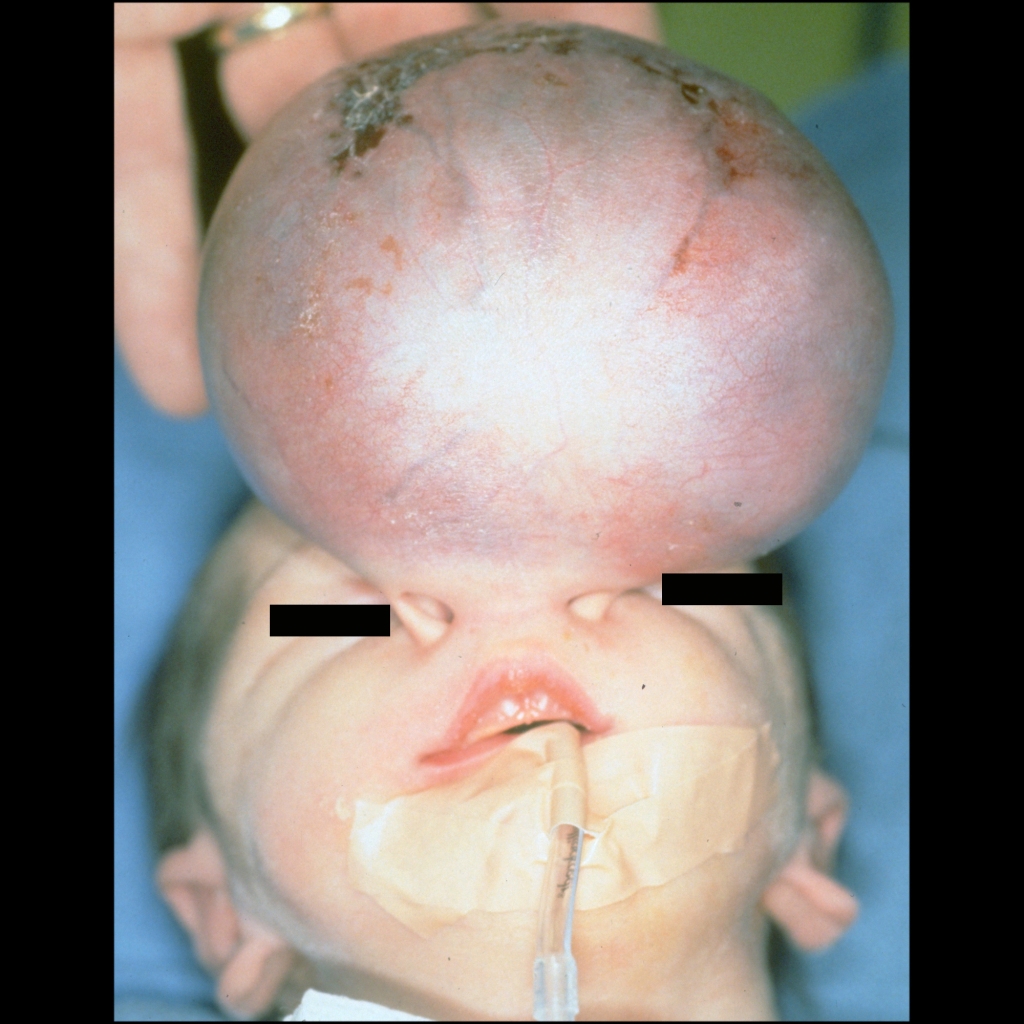 Clinical image of nasal teratoma