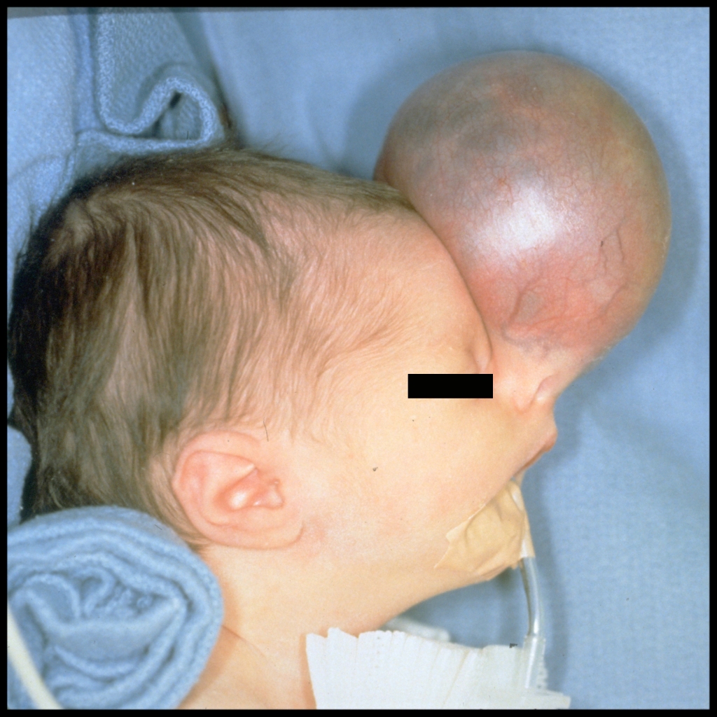 Clinical image of nasal teratoma