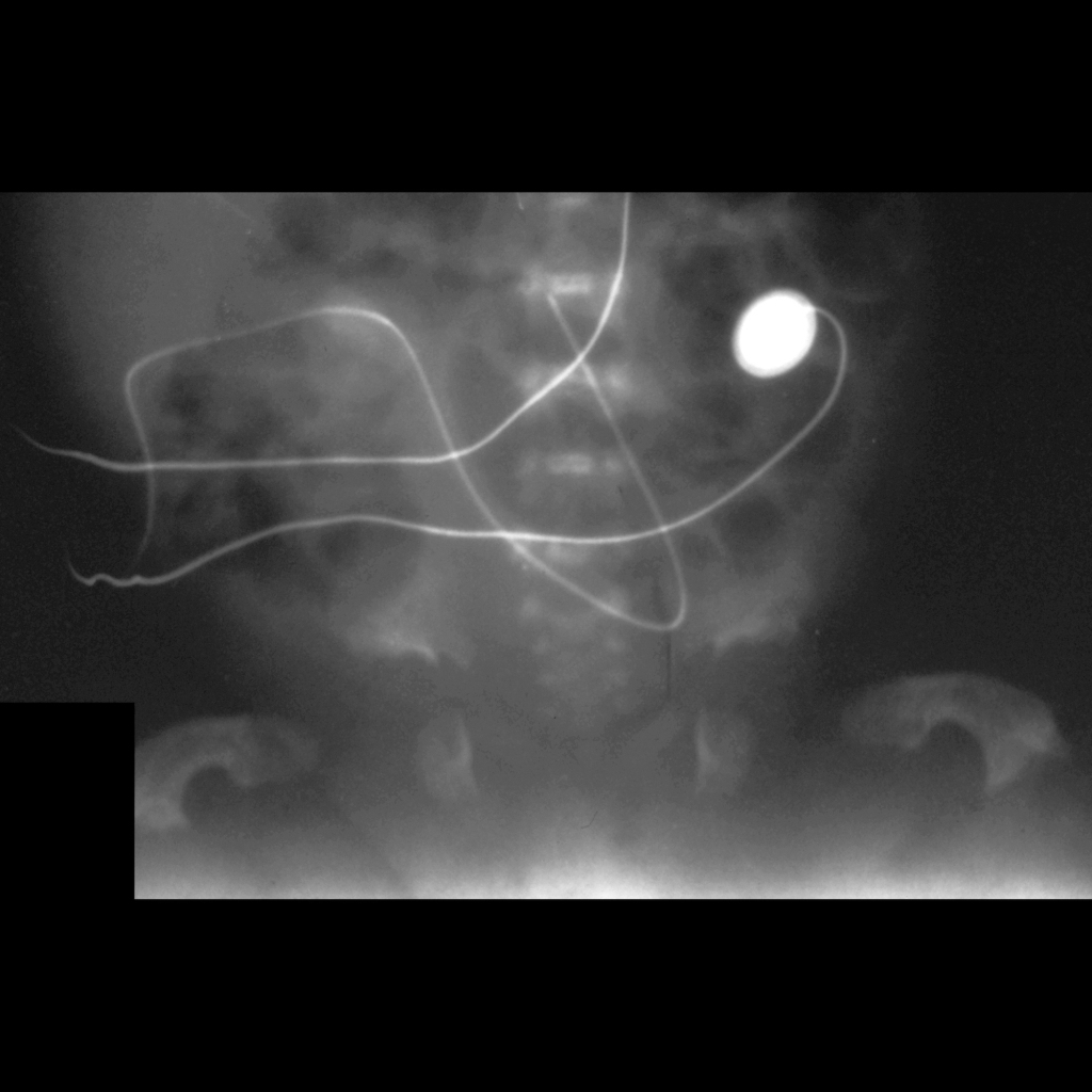 Pelvis radiograph of thanatophoric dysplasia