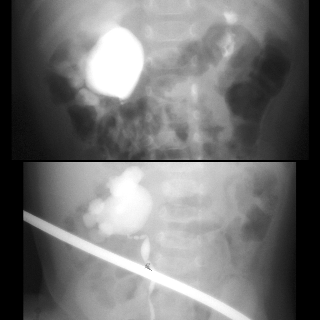 IVP of ureteropelvic junction obstruction due to a crossing vessel