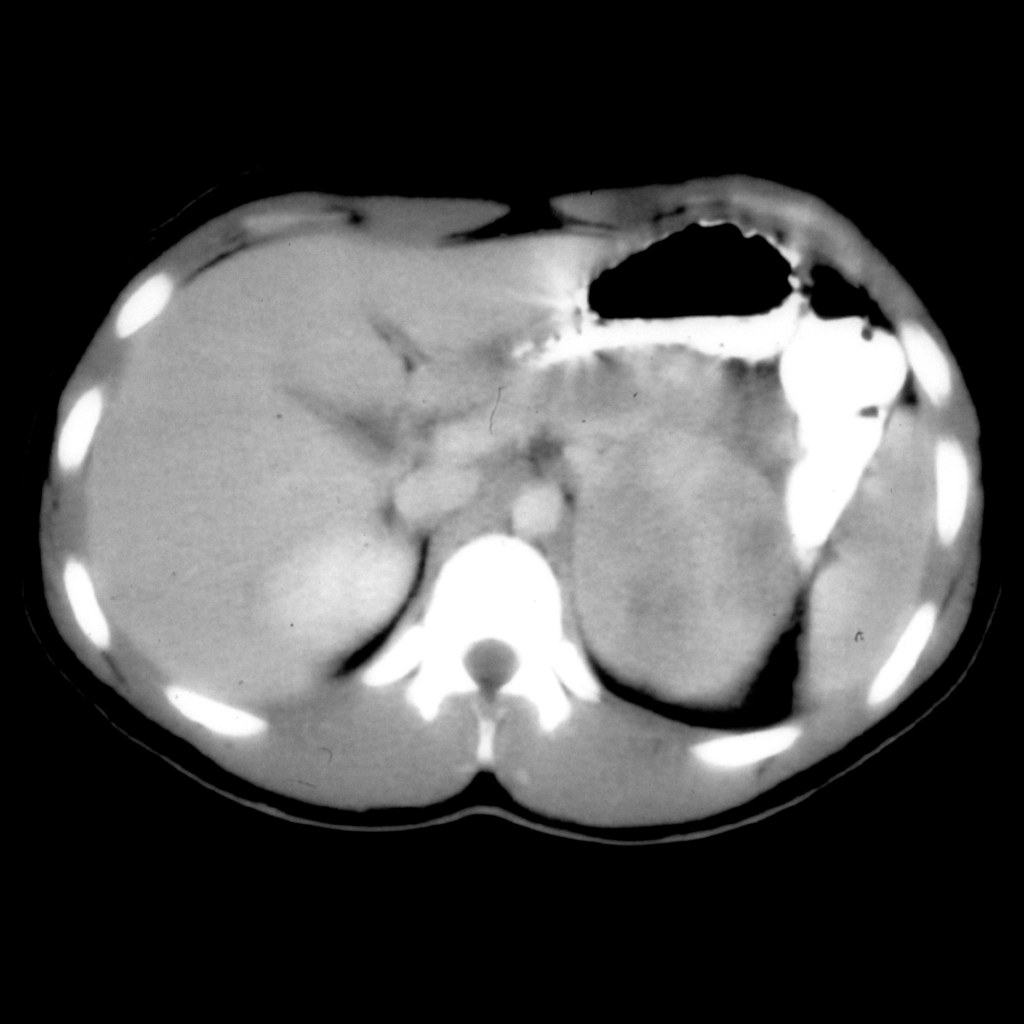 CT of adrenocortical carcinoma