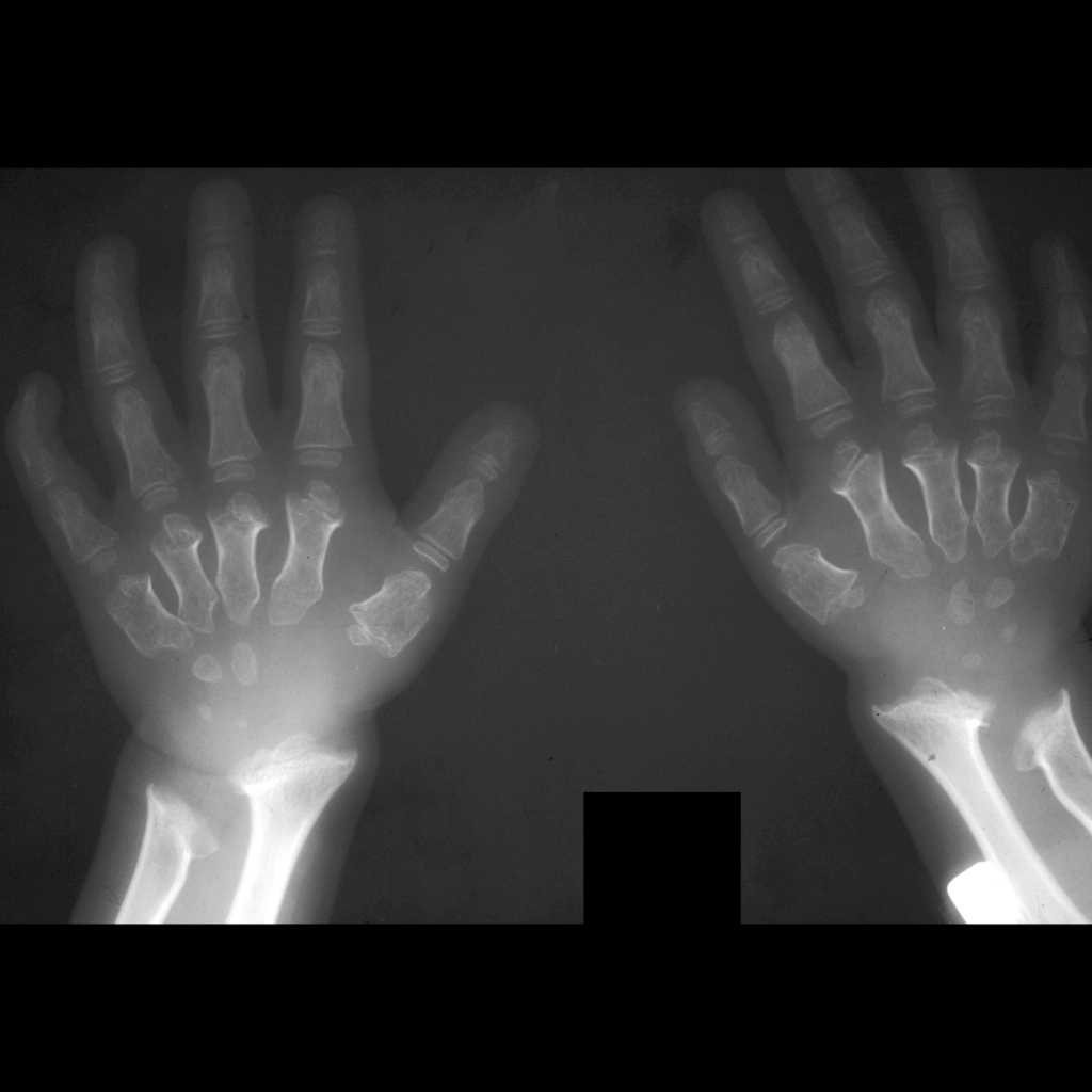 Radiograph of hands in Morquio syndrome