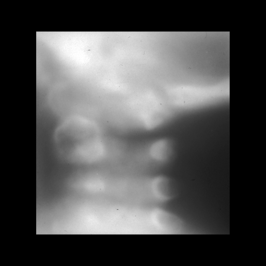 Radiograph of hypoplasia of the odontoid in Morquio syndrome