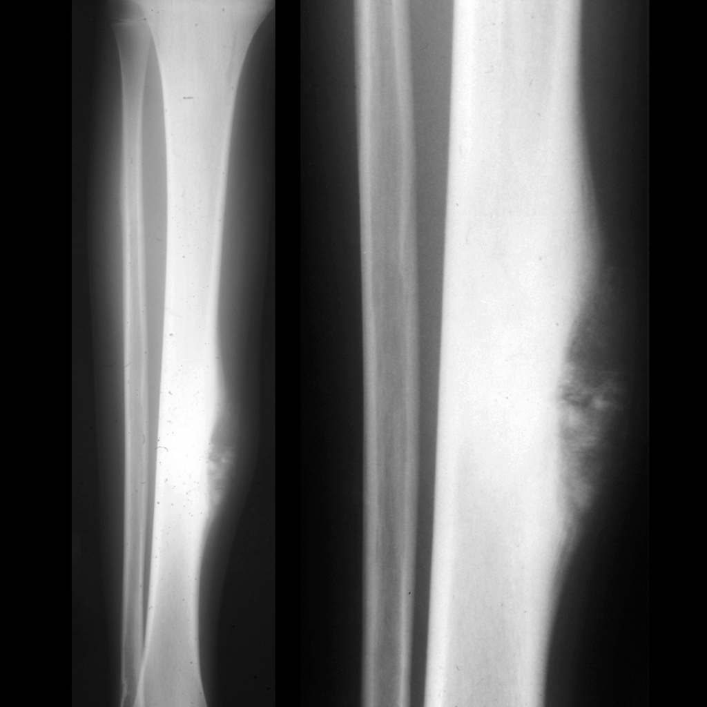 Radiograph of osteosarcoma of the tibia