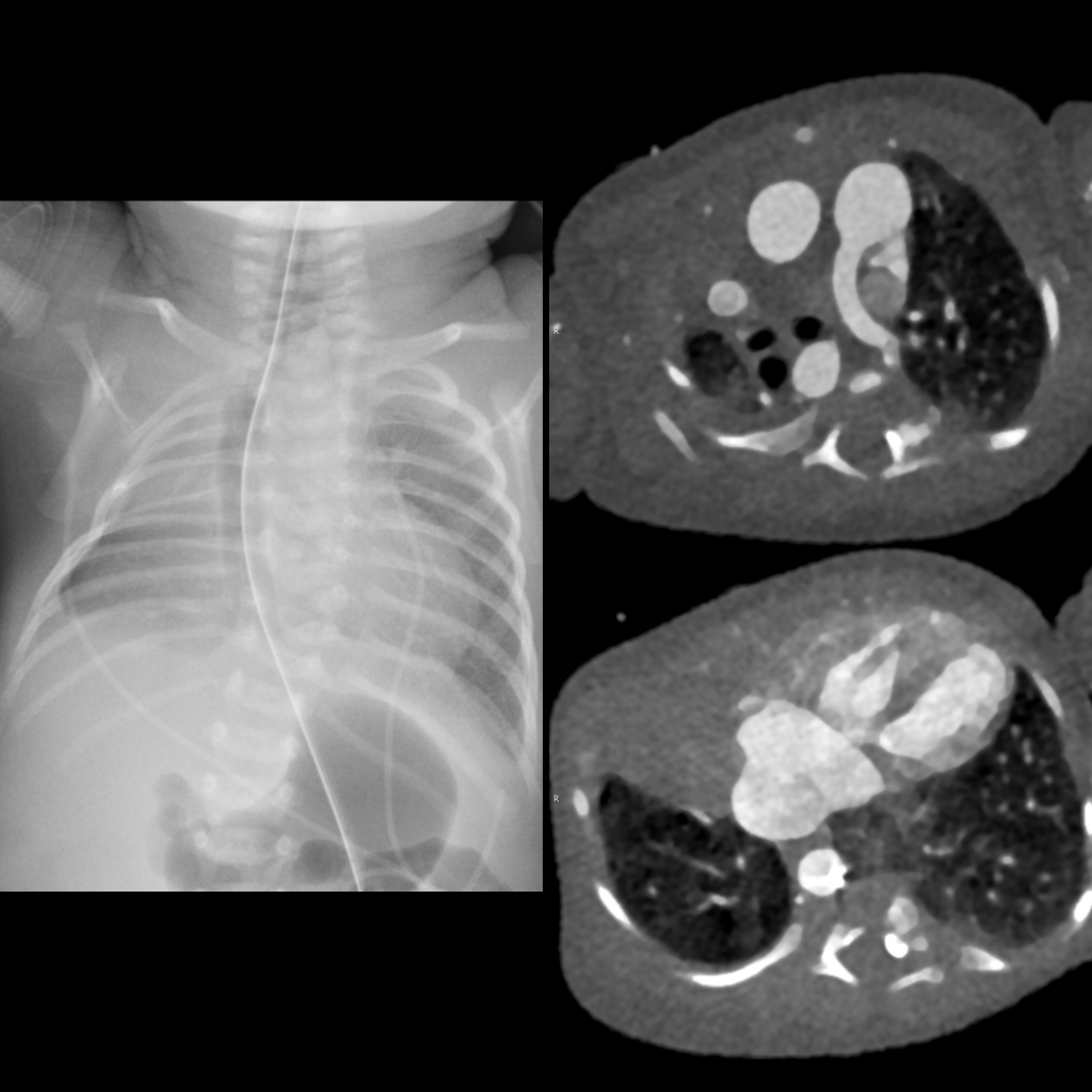 CXR and CT of pulmonary agenesis