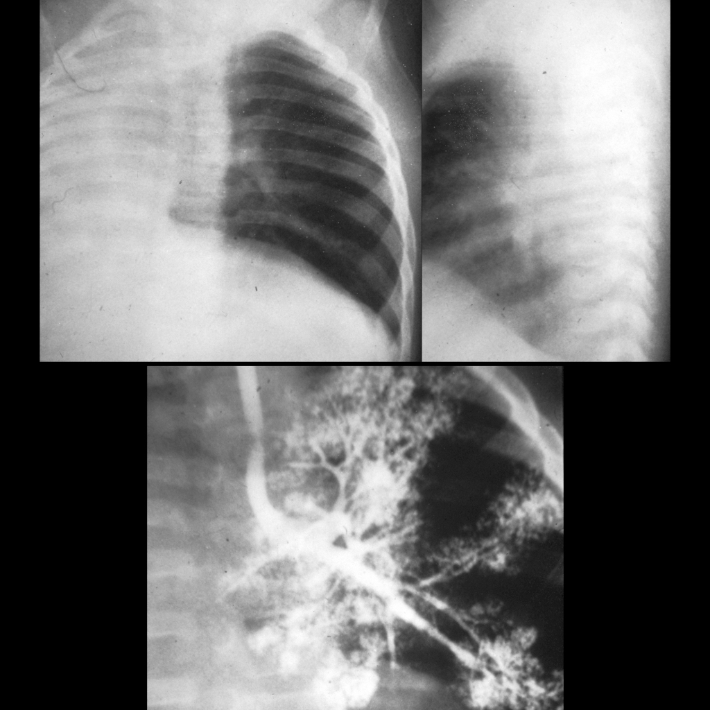CXR and bronchogram of pulmonary agenesis