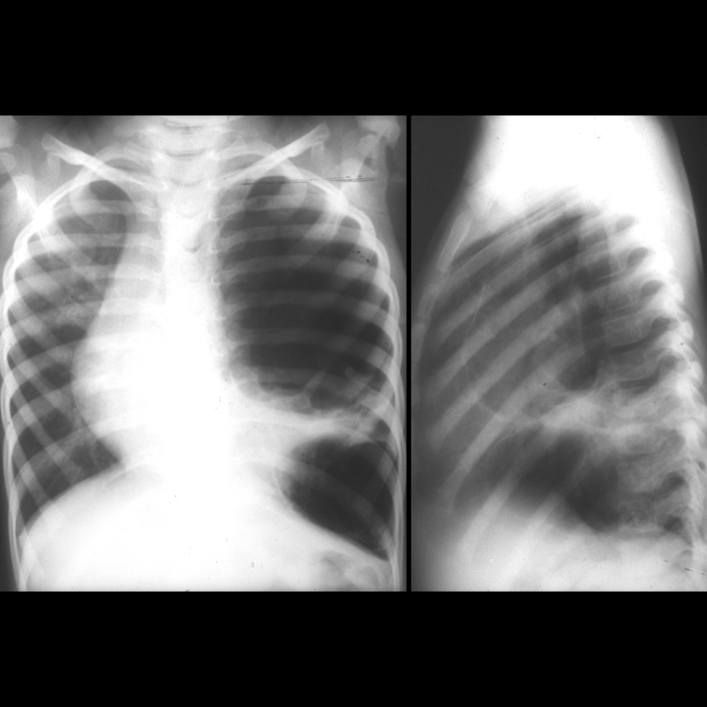 CXR of congenital pulmonary airway malformation Type I