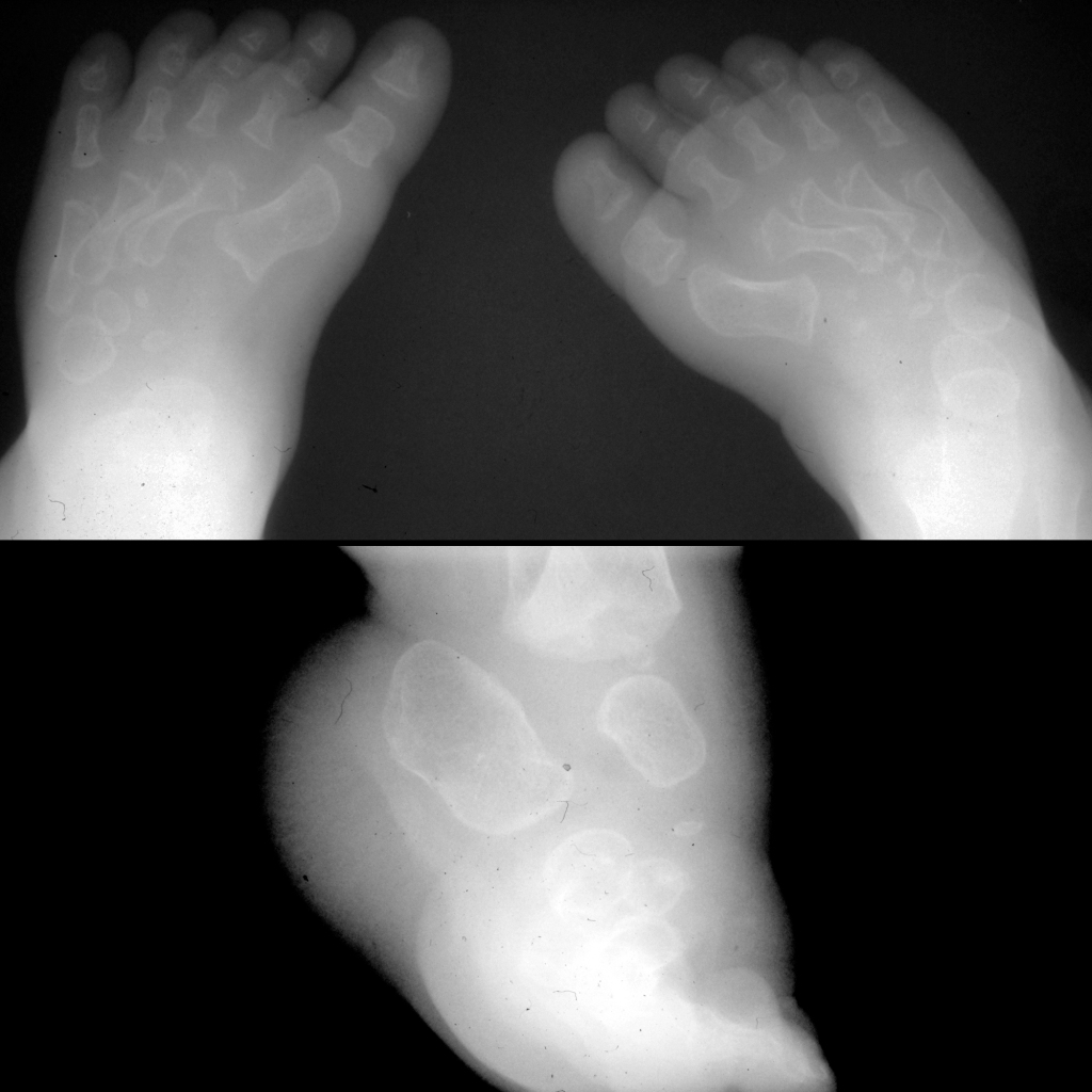 Radiograph of feet in diastrophic dysplasia