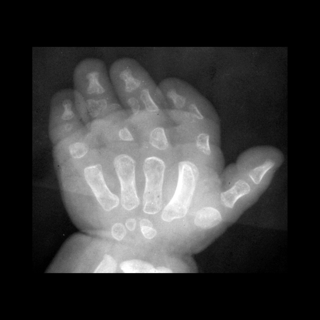 Radiograph of the hands in diastrophic dysplasia