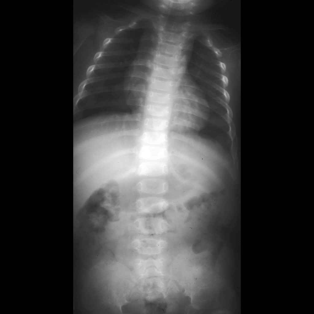 Spine radiograph of diastrophic dysplasia