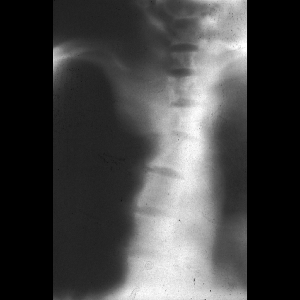 Tomogram of plexiform neurofibroma causing painful scoliosis