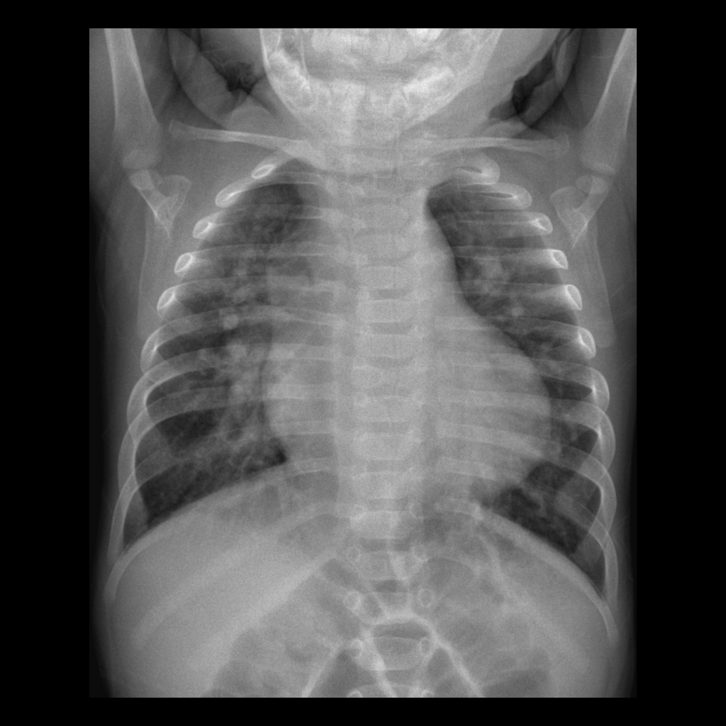 CXR of right aortic arch with aberrant left subclavian artery in a patient with ventricular septal defect