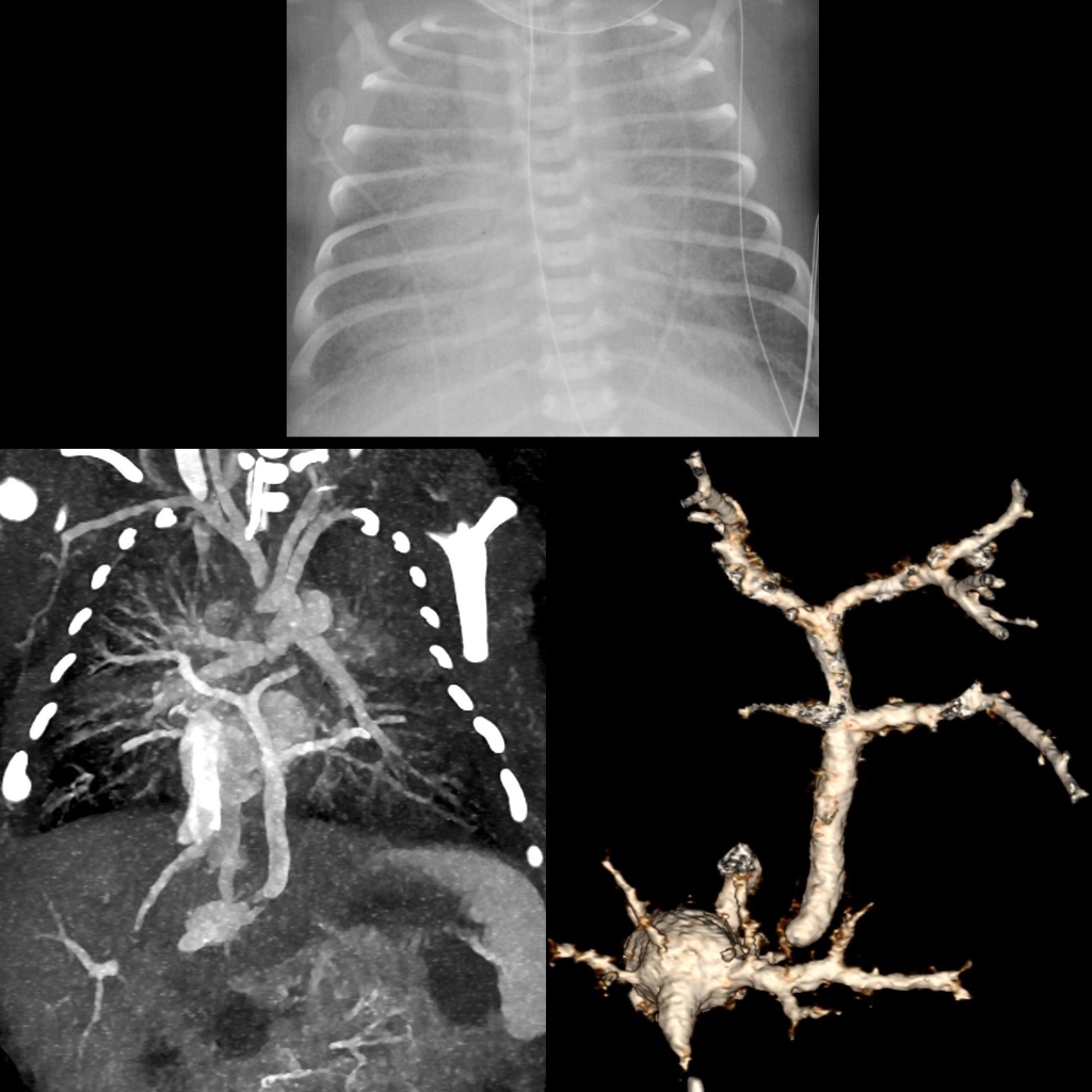 CXR and CT of infracardiac total anomalous pulmonary venous return