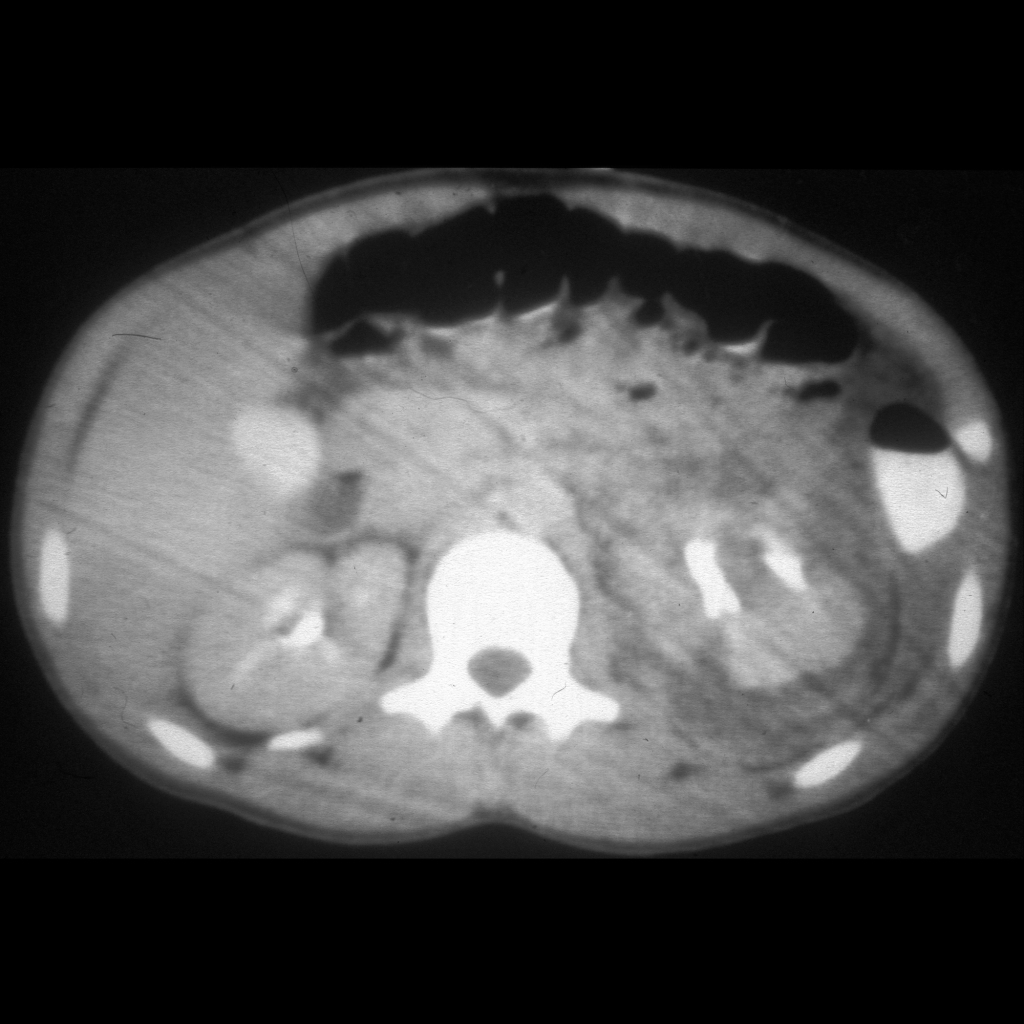CT of renal laceration