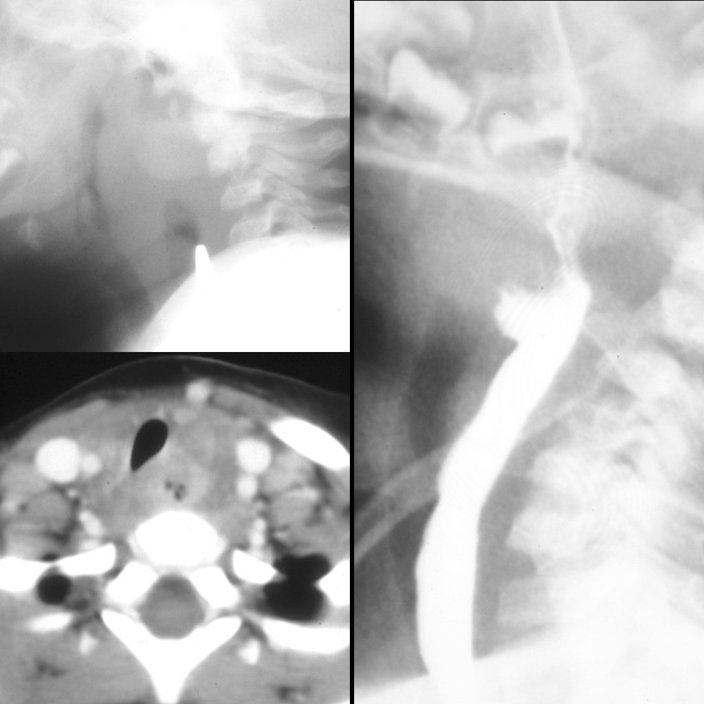 Radiograph and CT and UGI of chronic esophageal foreign body and retropharyngeal abscess