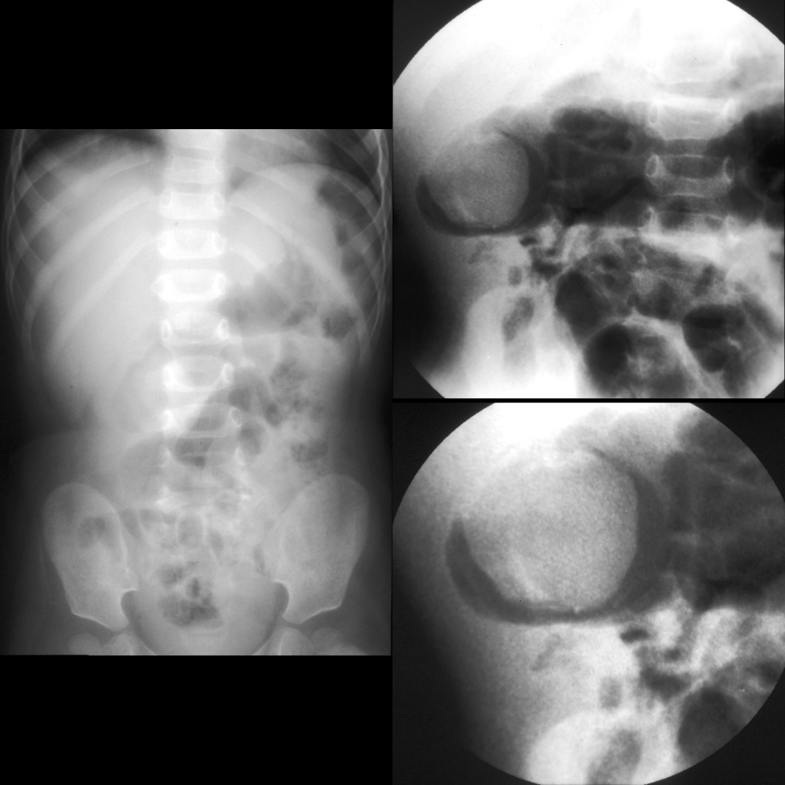 Toddler with crampy abdominal pain
