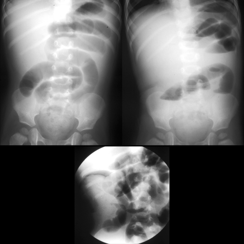 AXR of small bowel obstruction due to ileocolic intussusception