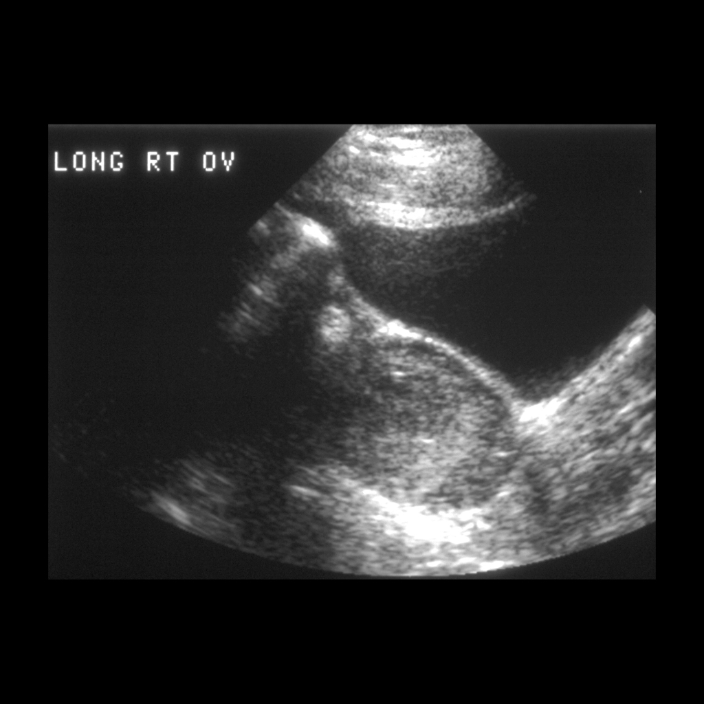 US of hemorrhagic ovarian cyst