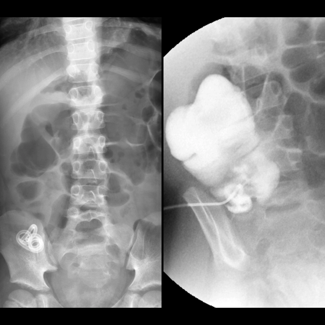 Cecostomy tube injection showing cecostomy tube in the correct position in the cecum