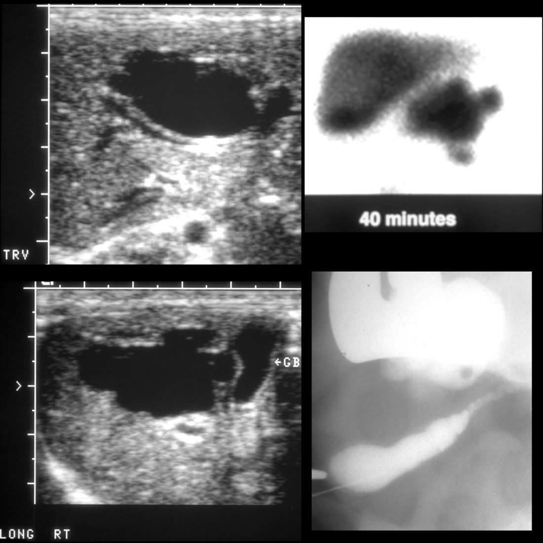 Newborn with a cystic right upper quadrant mass on prenatal US