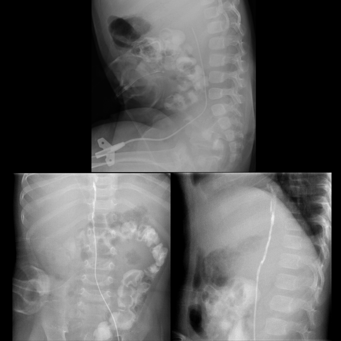 Infant with a femoral line that does not infuse