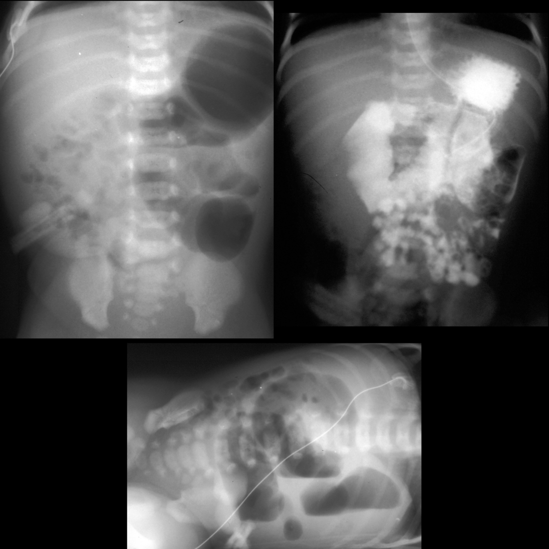 Newborn with polyhydramnios on prenatal US and bilious vomiting