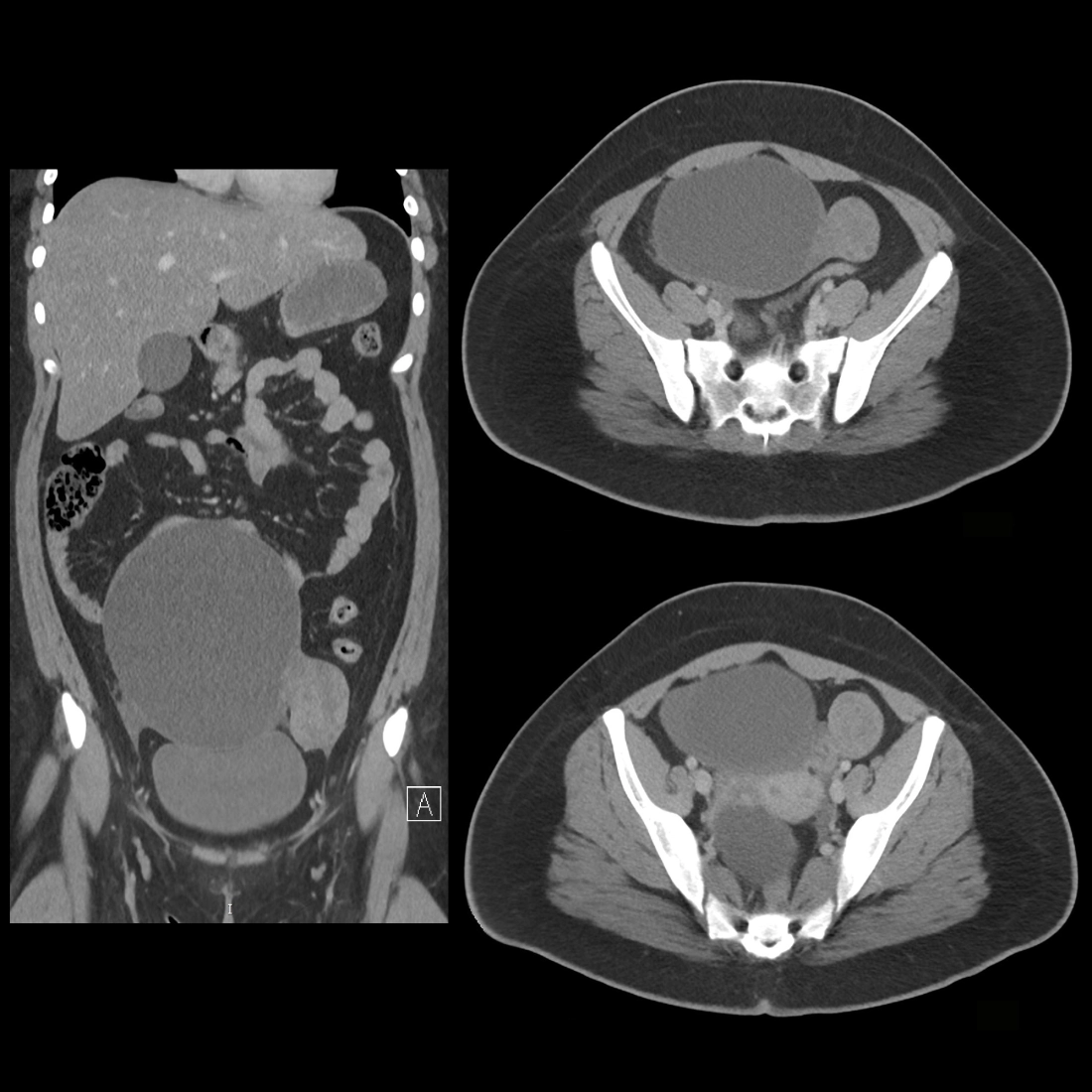 Ruptured ovarian cyst, Radiology Reference Article