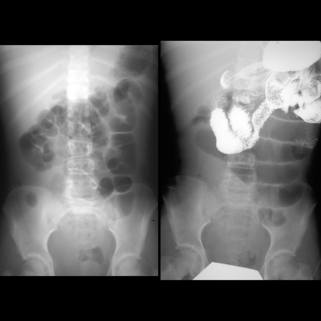 AXR and upper GI and small bowel followthrough of small bowel obstruction due to adhesions