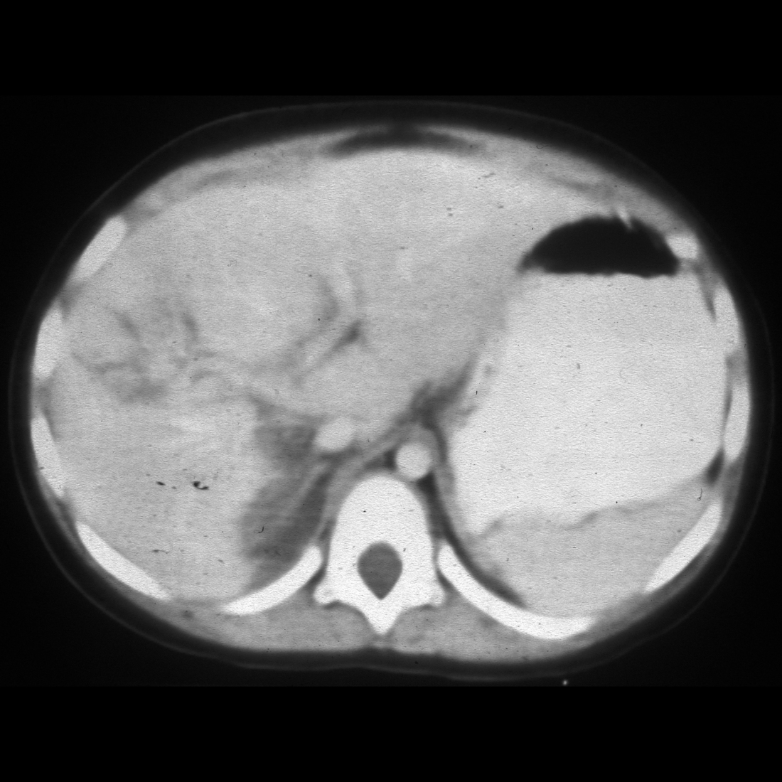 CT of liver laceration and adrenal hemorrhage